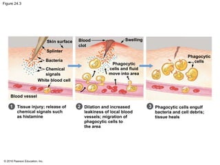 © 2016 Pearson Education, Inc.
Figure 24.3
Skin surface
Splinter
Bacteria
Chemical
signals
White blood cell
Blood vessel
Blood
clot
Swelling
Phagocytic
cells and fluid
move into area
Phagocytic
cells
Tissue injury; release of
chemical signals such
as histamine
Dilation and increased
leakiness of local blood
vessels; migration of
phagocytic cells to
the area
Phagocytic cells engulf
bacteria and cell debris;
tissue heals
3
2
1
 