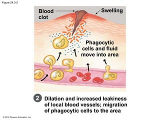 © 2016 Pearson Education, Inc.
Figure 24.3-2
Blood
clot
Swelling
Phagocytic
cells and fluid
move into area
Dilation and increased leakiness
of local blood vessels; migration
of phagocytic cells to the area
2
 