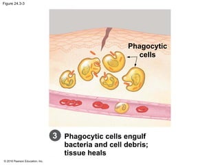 © 2016 Pearson Education, Inc.
Figure 24.3-3
Phagocytic
cells
Phagocytic cells engulf
bacteria and cell debris;
tissue heals
3
 