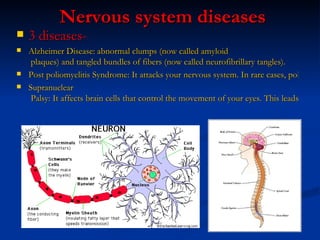 Nervous system diseases 3 diseases- Alzheimer Disease: abnormal clumps (now called  amyloid  plaques) and tangled bundles of fibers (now called  neurofibrillary  tangles). Post poliomyelitis Syndrome: It attacks your nervous system. In rare cases, polio infection can cause paralysis. Supranuclear  Palsy: It affects brain cells that control the movement of your eyes. This leads to serious and permanent problems with balance and the way you walk. 