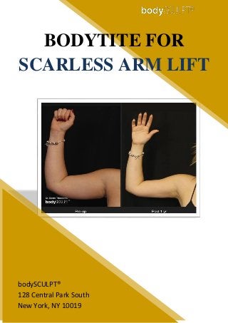 BODYTITE FOR
SCARLESS ARM LIFT
bodySCULPT®
128 Central Park South
New York, NY 10019
 