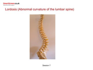 Session 7
Lordosis (Abnormal curvature of the lumbar spine)
 