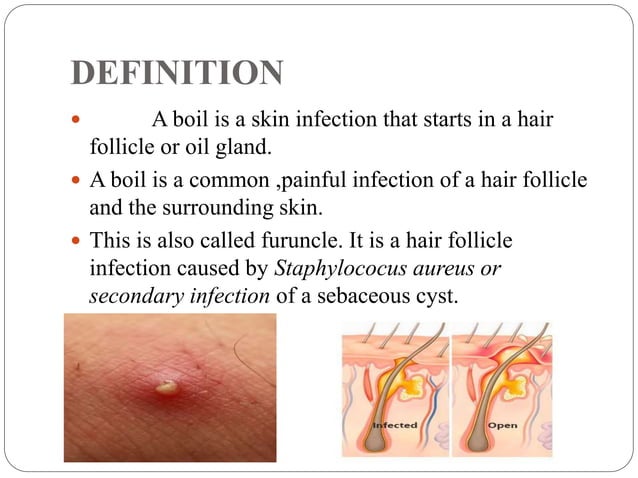Boils | PPT