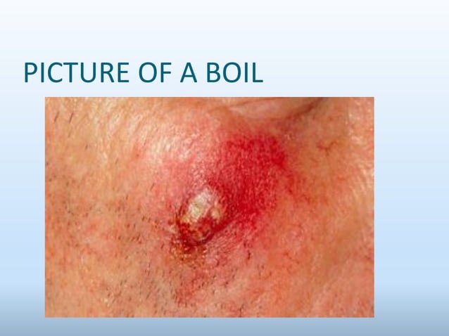 boilsandcarbuncles-240910013631-b1b11c3a.pdf