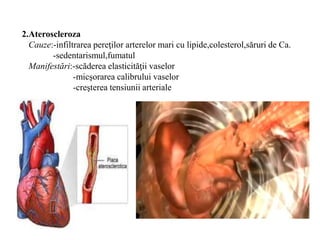 2.Ateroscleroza
Cauze:-infiltrarea pereţilor arterelor mari cu lipide,colesterol,săruri de Ca.
-sedentarismul,fumatul
Manifestări:-scăderea elasticităţii vaselor
-micşorarea calibrului vaselor
-creşterea tensiunii arteriale
 