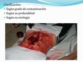 Clasificación:
 Según grado de contaminación
 Según su profundidad
 Según su etiología
 