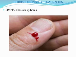 HERIDAS SEGÚN SU CONTAMINACIÓN
 LIMPIAS: hasta las 3 horas.
 
