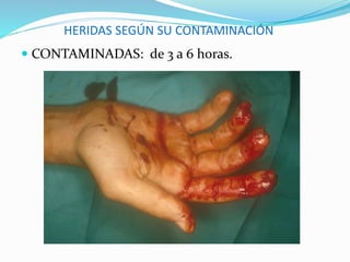 HERIDAS SEGÚN SU CONTAMINACIÓN
 CONTAMINADAS: de 3 a 6 horas.
 