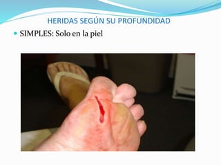 HERIDAS SEGÚN SU PROFUNDIDAD
 SIMPLES: Solo en la piel
 