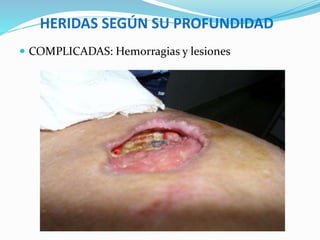 HERIDAS SEGÚN SU PROFUNDIDAD
 COMPLICADAS: Hemorragias y lesiones
 