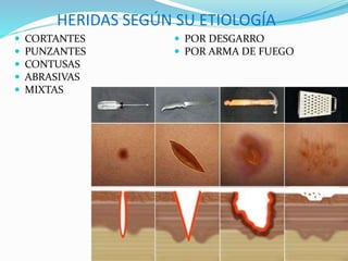 HERIDAS SEGÚN SU ETIOLOGÍA
 CORTANTES
 PUNZANTES
 CONTUSAS
 ABRASIVAS
 MIXTAS
 POR DESGARRO
 POR ARMA DE FUEGO
 