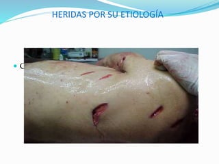 HERIDAS POR SU ETIOLOGÍA
 CORTANTES: Rectos o en bisel.
 