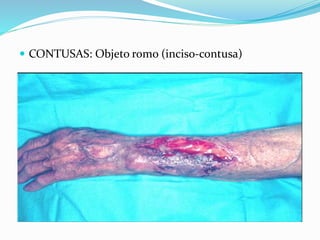 CONTUSAS: Objeto romo (inciso-contusa)
 