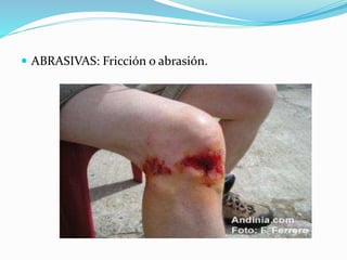  ABRASIVAS: Fricción o abrasión.
 
