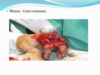  Mixtas: Corto contusas .
 