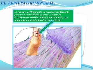 La ruptura del ligamento se reconoce mediante la
presencia de movilidad anormal cuando la
articulación a sido forzada en su resistencia , con
tendencia a la desviación de la articulación .
 