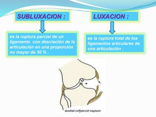SUBLUXACION : LUXACION :
es la ruptura parcial de un
ligamento con desviación de la
articulación en una proporción
no mayor de 30 % .
es la ruptura total de los
ligamentos articulares de
una articulación .
 