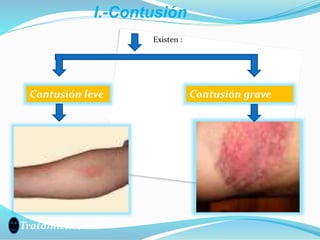 I.-Contusión
Existen :
Contusión leve Contusión grave
Tratamiento :
 