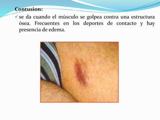 Contusion:
 se da cuando el mùsculo se golpea contra una estructura
òsea. Frecuentes en los deportes de contacto y hay
presencia de edema.
 