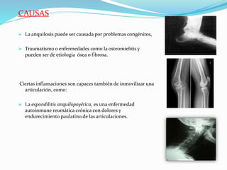 CAUSAS
 La anquilosis puede ser causada por problemas congénitos,
 Traumatismo o enfermedades como la osteomielitis y
pueden ser de etiología ósea o fibrosa.
Ciertas inflamaciones son capaces también de inmovilizar una
articulación, como:
 La espondilitis anquilopoyética, es una enfermedad
autoinmune reumática crónica con dolores y
endurecimiento paulatino de las articulaciones.
 