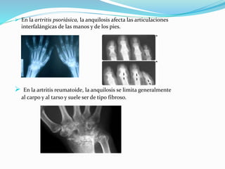  En la artritis psoriásica, la anquilosis afecta las articulaciones
interfalángicas de las manos y de los pies.
 En la artritis reumatoide, la anquilosis se limita generalmente
al carpo y al tarso y suele ser de tipo fibroso.
 