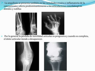 La anquilosis se presenta también en las variedades erosiva o inflamatoria de la
osteoartrosis y afecta predominantemente a las articulaciones interfalángicas
distales y rodillas
 Por lo general la pérdida de movilidad articular es progresiva y cuando es completa,
el dolor articular tiende a desaparecer.
 