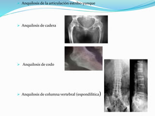  Anquilosis de la articulación estribo-yunque
 Anquilosis de cadera
 Anquilosis de codo
 Anquilosis de columna vertebral (espondilítica)
 