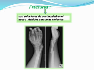 Fracturas :
son soluciones de continuidad en el
hueso , debidos a traumas violentos
 