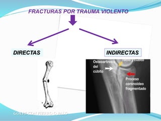 FRACTURAS POR TRAUMA VIOLENTO
DIRECTAS INDIRECTAS
GOLPE CON FIERRO O PALO
 