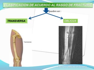 CLASIFICACION DE ACUERDO AL RASGO DE FRACTURA
pueden ser :
TRANSVERSA OBLICUA
Fractura oblicua en la tibia
 