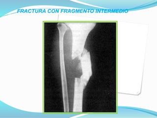 FRACTURA CON FRAGMENTO INTERMEDIO
 