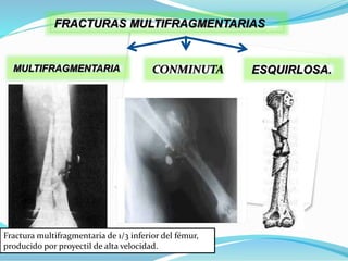 FRACTURAS MULTIFRAGMENTARIAS
MULTIFRAGMENTARIA CONMINUTA ESQUIRLOSA.
Fractura multifragmentaria de 1/3 inferior del fémur,
producido por proyectil de alta velocidad.
 