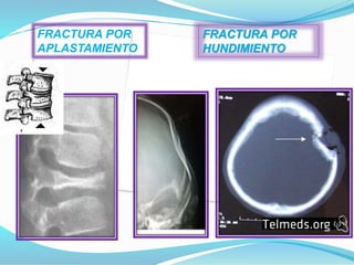 FRACTURA POR
APLASTAMIENTO
FRACTURA POR
HUNDIMIENTO
 