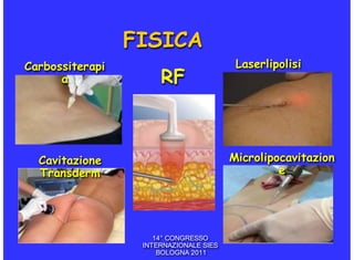 FISICA
Carbossiterapi                           Laserlipolisi
      a               RF



  Cavitazione                           Microlipocavitazion
  Transderm                                      e




                     14° CONGRESSO
                  INTERNAZIONALE SIES
                      BOLOGNA 2011
 