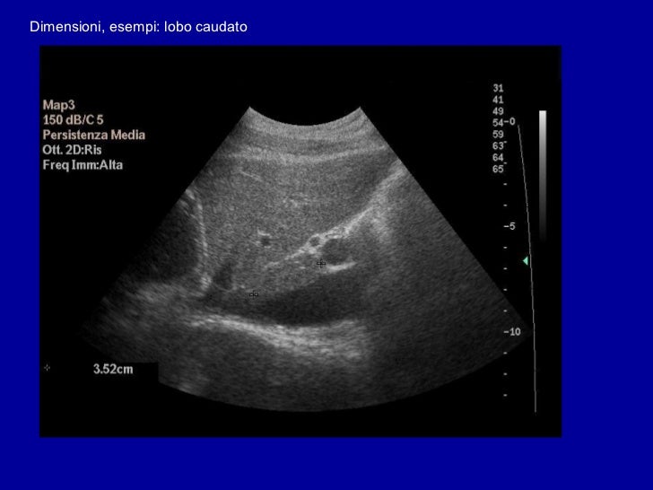 Diagnostica Per Immagini Nelle Epatopatie Croniche