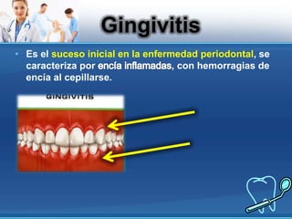 Es el suceso inicial en la enfermedad periodontal, se caracteriza por encía inflamadas, con hemorragias de encía al cepillarse.Gingivitis