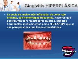 La encía se vuelve más inflamada, de color rojo brillante, con hemorragias frecuentes. Factores que contribuyen son: respiradores bucales, cambios hormonales, medicamentos como el DILANTIN  que se usa para personas que tienen convulsiones.Gingivitis HIPERPLÁSICA