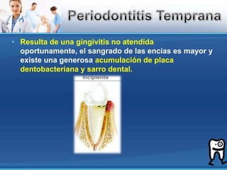 Resulta de una gingivitis no atendida oportunamente, el sangrado de las encías es mayor y existe una generosa acumulación de placa dentobacteriana y sarro dental.Periodontitis Temprana