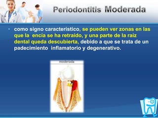 como signo característico, se pueden ver zonas en las que la  encía se ha retraído, y una parte de la raíz dental queda descubierta, debido a que se trata de un padecimiento  inflamatorio y degenerativo.PeriodontitisModerada