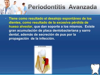 Tiene como resultado el desalojo espontáneo de los dientes, como resultado de la excesiva pérdida de hueso alveolar, que dan soporte a los mismos.  Existe gran acumulación de placa dentobacteriana y sarro dental, además de secreción de pus por la propagación  de la infección.Periodontitis  Avanzada