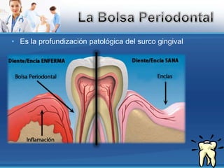 Es la profundización patológica del surco gingivalLa Bolsa Periodontal