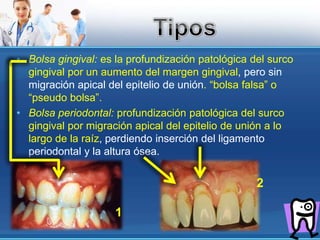 Bolsa gingival: es la profundización patológica del surco gingival por un aumento del margen gingival, pero sin migración apical del epitelio de unión. “bolsa falsa” o “pseudo bolsa”.Bolsa periodontal: profundización patológica del surco gingival por migración apical del epitelio de unión a lo largo de la raíz, perdiendo inserción del ligamento periodontal y la altura ósea.Tipos21
