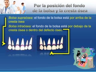 Bolsa supraósea:el fondo de la bolsa está por arriba de la cresta óseaBolsa intraósea:el fondo de la bolsa está por debajo de la cresta ósea o dentro del defecto óseo.Por la posición del fondo de la bolsa y la cresta ósea