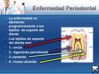 La enfermedad va afectando progresivamente a los tejidos  de soporte del diente Los tejidos de soporte del diente son:  1.- encía2.- ligamento periodontal3.-cemento4.- hueso alveolarEnfermedad Periodontal