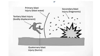 Blast Injuries Examples Bomb and blast injury | PPTX