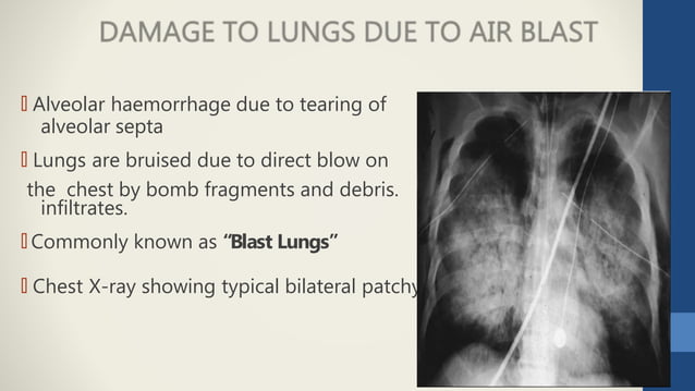 BOMB BLAST INJURIES.pptx