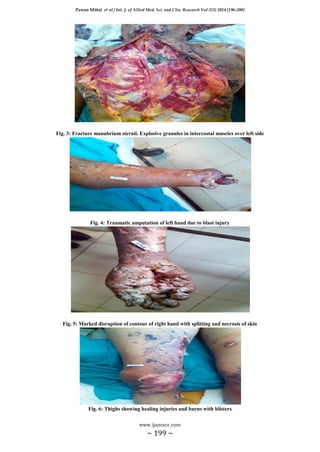 Pawan Mittal et al / Int. J. of Allied Med. Sci. and Clin. Research Vol-2(3) 2014 [196-200]
www.ijamscr.com
~ 199 ~
Fig. 3: Fracture manubrium sternii. Explosive granules in intercostal muscles over left side
Fig. 4: Traumatic amputation of left hand due to blast injury
Fig. 5: Marked disruption of contour of right hand with splitting and necrosis of skin
Fig. 6: Thighs showing healing injuries and burns with blisters
 