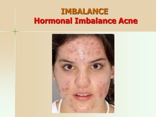 IMBALANCE
Hormonal Imbalance Acne
 
