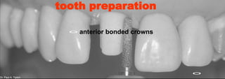 Dr. Paul A. Tipton
anterior bonded crowns
Dr. Paul A. Tipton
tooth preparation
 