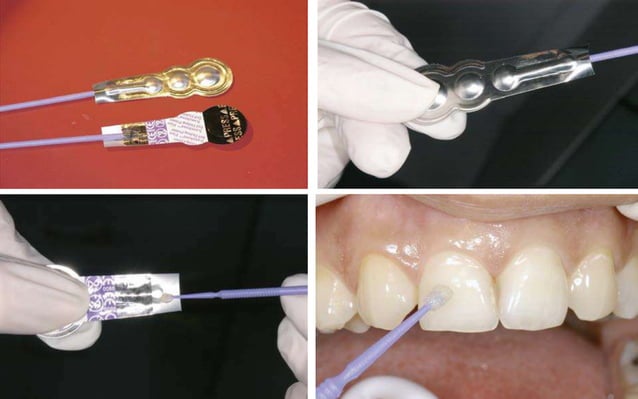 BONDING in orthodontics techniques .pptx | Dental Health | Diseases and ...